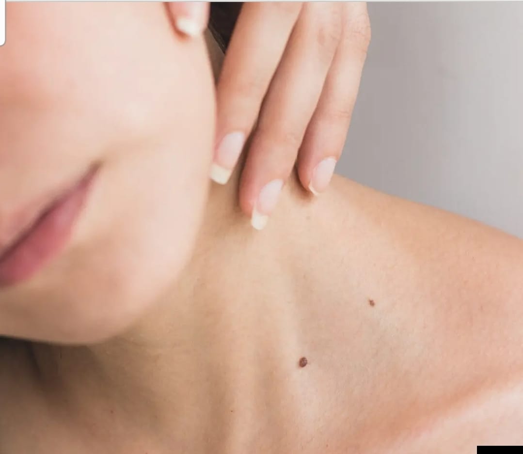 Gros plan d’un visage et du cou d’une femme, peau lumineuse avec grains de beauté — teint lumineux ménopause